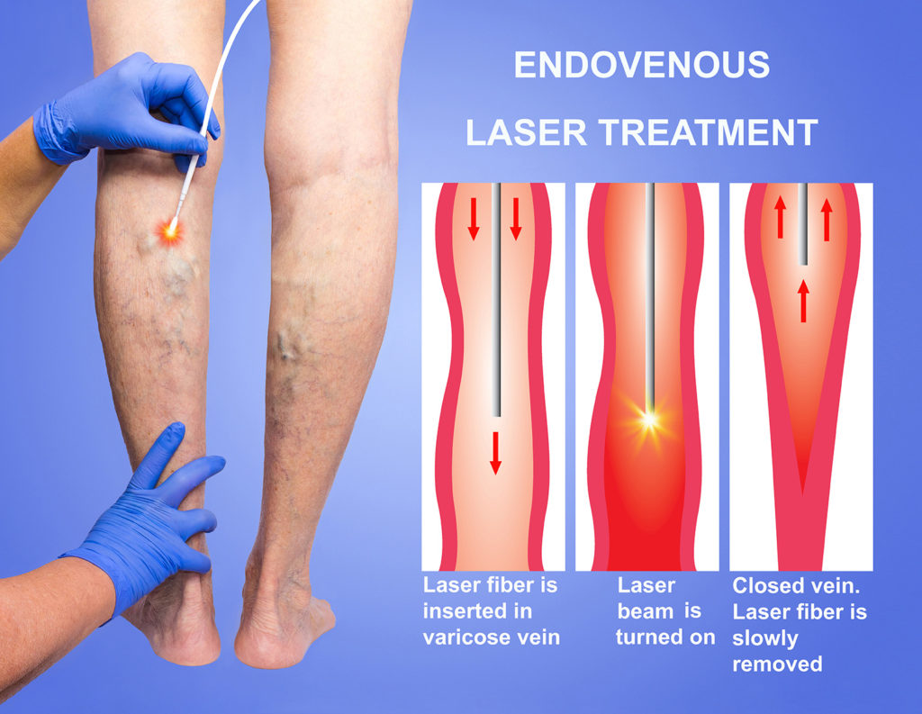 Endovenous Laser Therapy EVLT Treating Varicose Veins SIFSOF