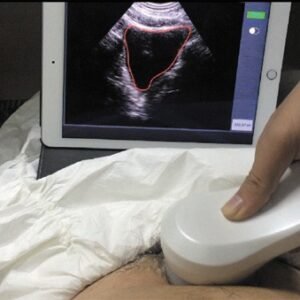 Wireless Bladder Ultrasound Scanner 4D array scan SIFULTRAS-5.5 with patient