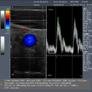 SIFULTRAS-7.1 Portable Color Doppler Ultrasound Scanner PW scan result