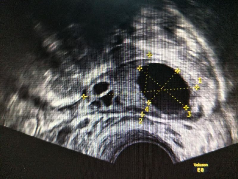 Wireless Transvaginal Ultrasound Scanner FDA SIFULTRAS-5.36 scan 