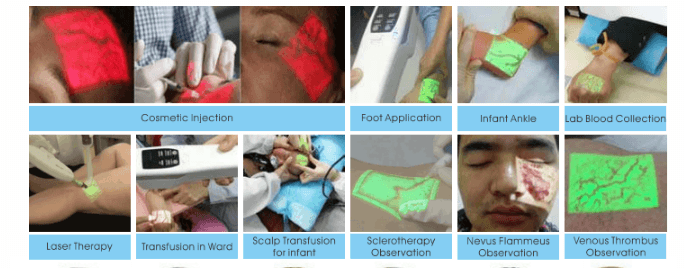 FDA Portable Vein Detector SIFVEIN-5.2 application 