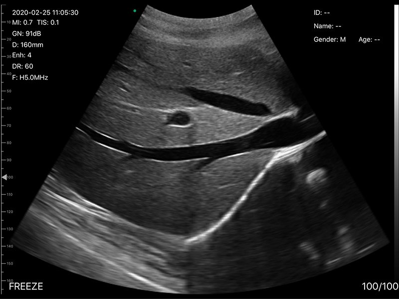Scan result portable ultrasound scanner