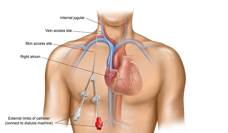 CVC Central Venous Catheter SIFSOF