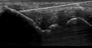 Dry needling ultrasound scan