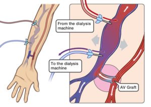 Insertion of percutaneous hemodialysis catheter