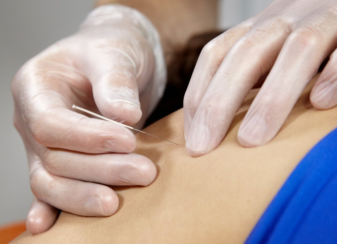 Dry needling is a technique Physical Therapists use for the treatment of pain and movement impairs. It is basically the use of short, thin, stainless steel needles. To penetrate the affected tendon tissue, tight areas or knots in the muscles. Without the need to inject any medication or fluid.