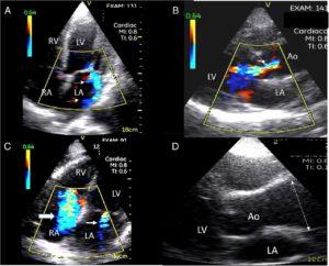 FOCUS using the portable ultrasound scanner SIFULTRAS-5.42