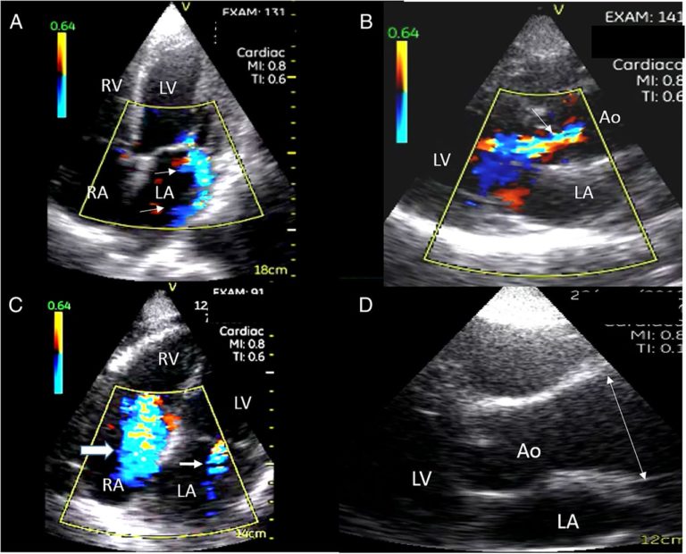 Focused Cardiac Ultrasound Focus Sifultras Sifsof