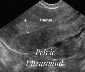 Pelvic Ultrasound