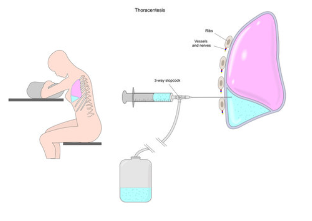 A pleural effusion is an abnormal collection of fluid in the pleural space. Removal of this fluid by needle aspiration is called a thoracentesis. The latter can be both diagnostic and therapeutic for the patient.