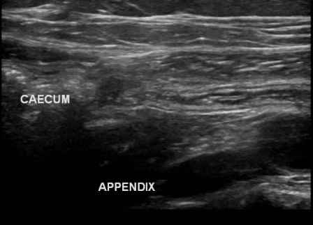 Appendicitis : appendix and caecum