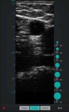 Portable Linear Ultrasound Scanner SIFULTRAS-5.15 For Vascular Surgeon Basilic Vein Clinic Ultrasound Image