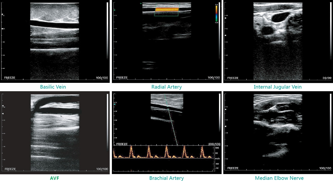 Built-in Screen Linear Ultrasound Scanner SIFULTRAS-5.14 SCAN RESULTS