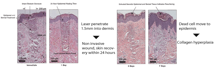 Surgery Diode Laser System SIFLASER-2.1 Operation