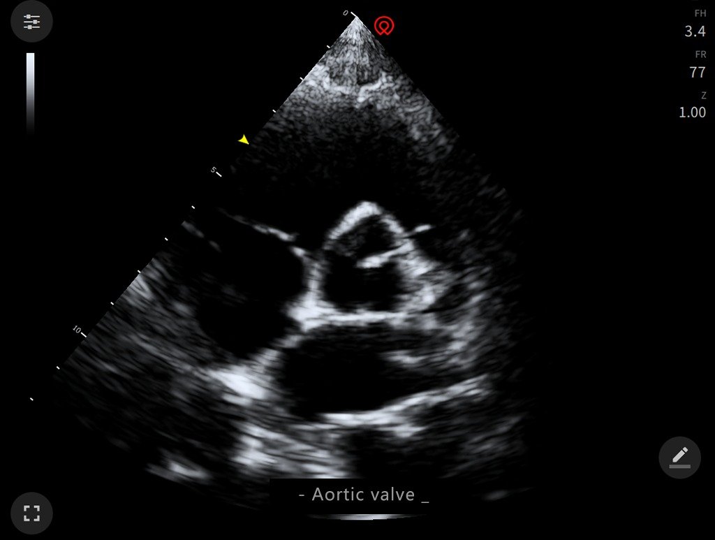 Multi-Head 13 Inch Screen Ultrasound Scanner SIFULTRAS-4.8 Aortic Scan