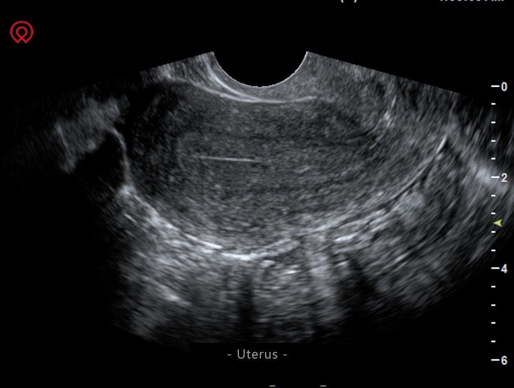 Multi-Head 13 Inch Screen Ultrasound Scanner SIFULTRAS-4.8 Uterus Scan
