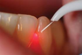 Dental Medical Diode Laser SIFLASER-3.0 in use