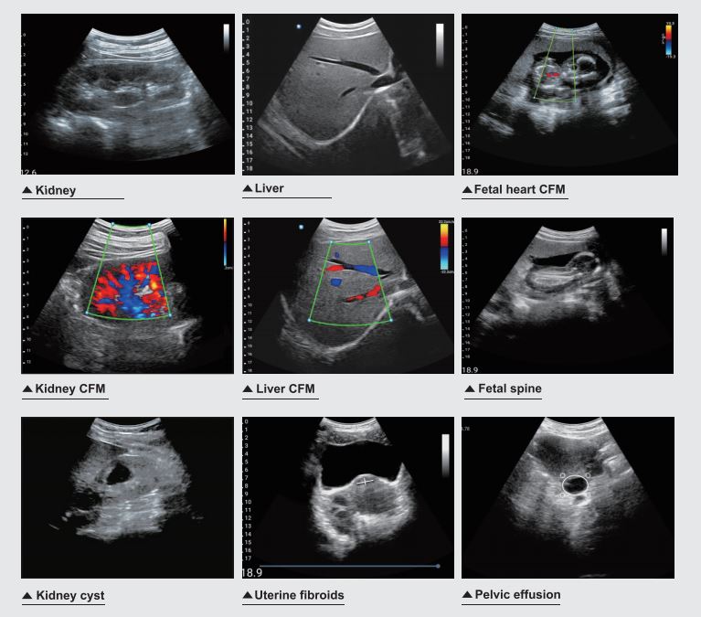 Color Doppler WiFi Convex Ultrasound Scanner SIFULTRAS-5.28 Scan results 