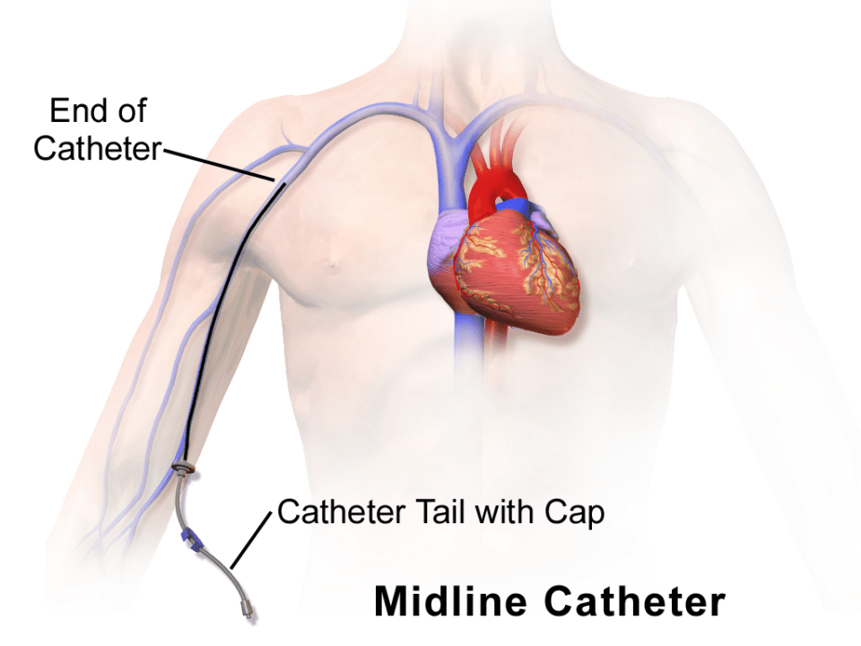 Midline Catheter Insertion