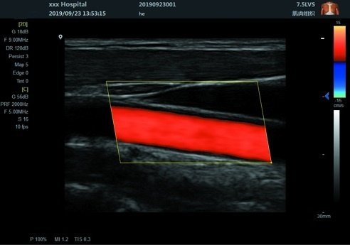 Scan Results of  Notebook Color Doppler Ultrasound Scanner SIFULTRAS-8.31
