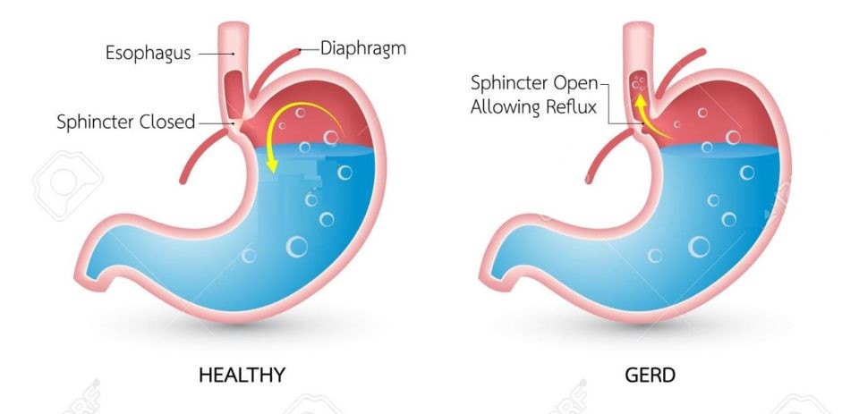 Gastroesophageal-Reflux-Disease-GERD – SIFSOF