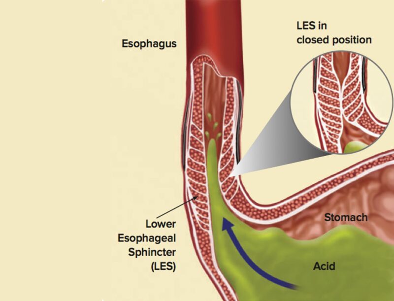 Gastroesophageal Reflux Disease (GERD) - SIFSOF