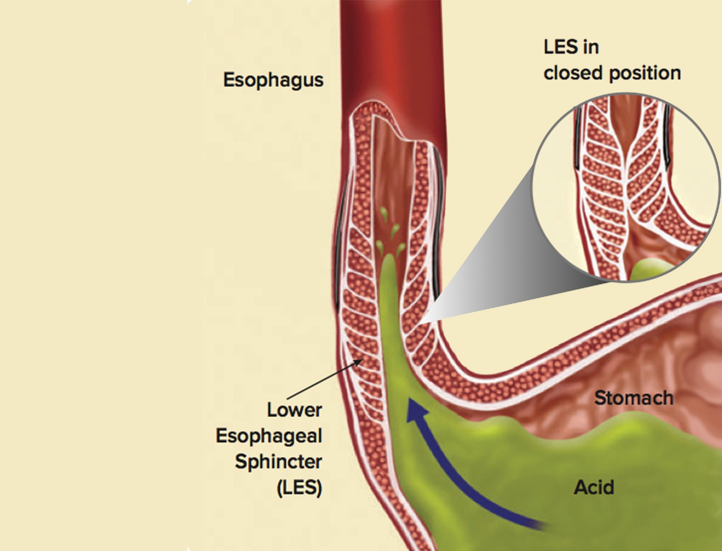 Gastroesophageal Reflux Disease Gerd Sifsof