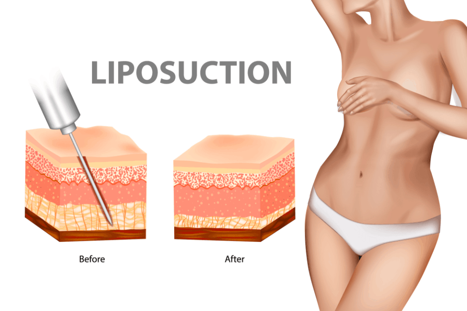 Ultrasound guided Liposuction