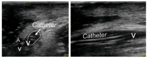 Midline-ultrasound