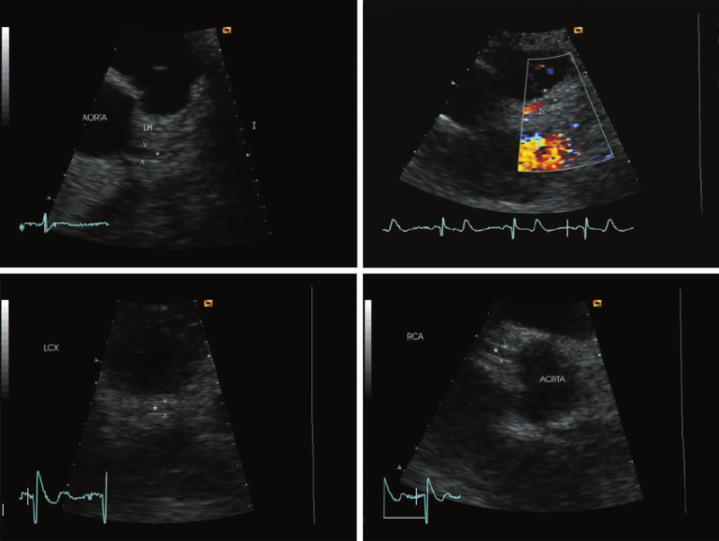 TTE : Transthoracic Echocardiogram - SIFSOF . CA