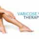 Vericose vein thearpy - SIFVEIN Vein Finder Articles