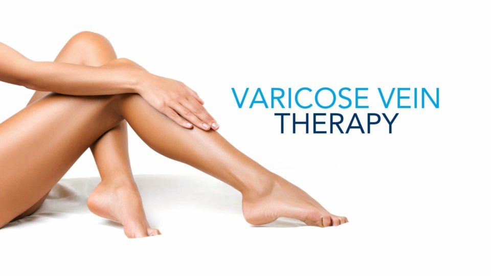 Vericose vein thearpy - SIFVEIN Vein Finder Articles