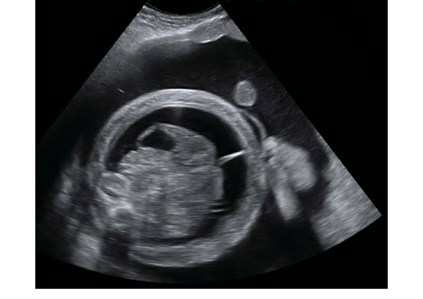 Fetal Morphology Assessment Ultrasound Scan FMA