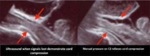 neuro-monitoring ultrasound