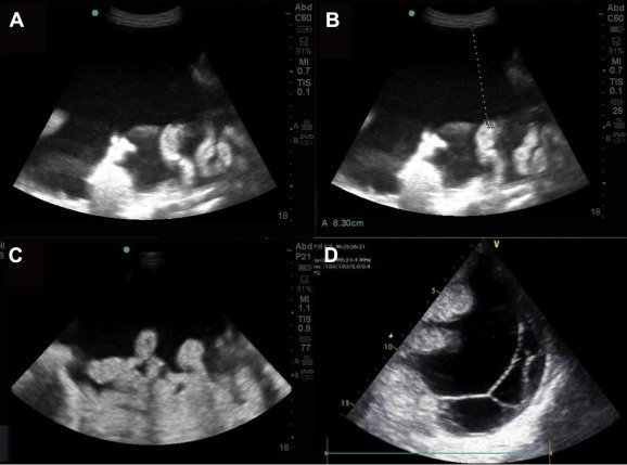 Bedside ultrasound-guided paracentesis