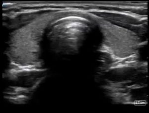 ULTRASOUND guided AIRWAY ASSESSMENT