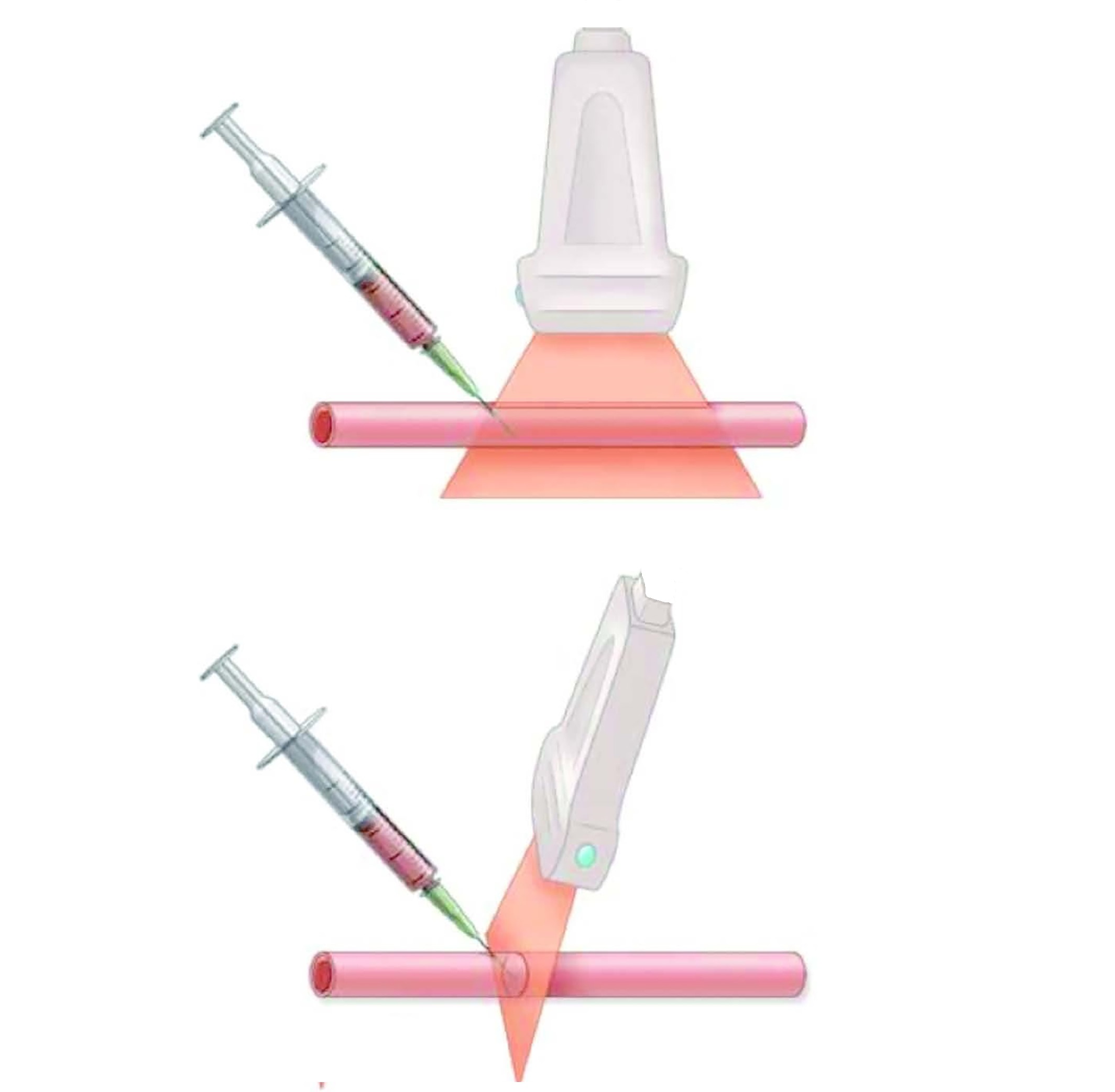 Vascular cannulation