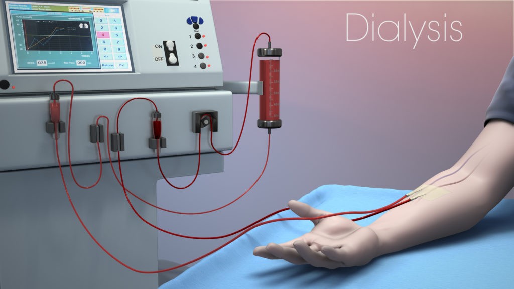 Vein Finder use in Dialysis – SIFSOF