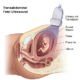 fetal ultrasound transabdominal