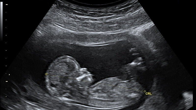 fetal ultrasound 