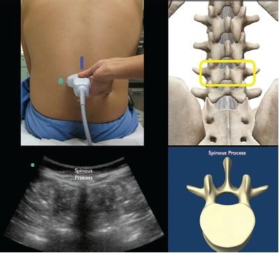 Ultrasound Guided Lumbar Puncture