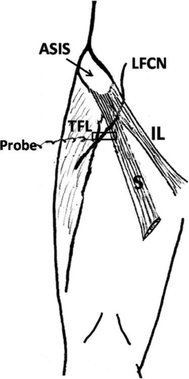 Ultrasound of the lateral femoral cutaneous nerve
