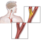 Carotid_artery_stenosis