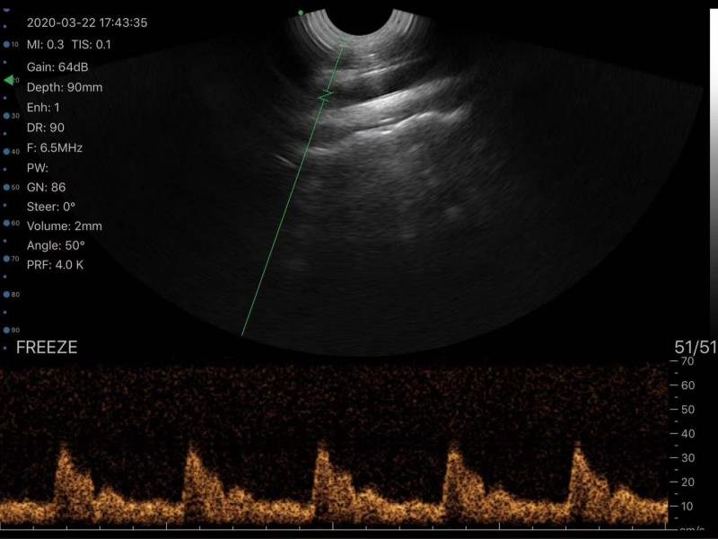 Wireless Transvaginal Ultrasound Scanner Color Doppler FDA SIFULTRAS-6.36 scan