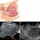 The use of Color Doppler Ultrasound with Transvaginal probe