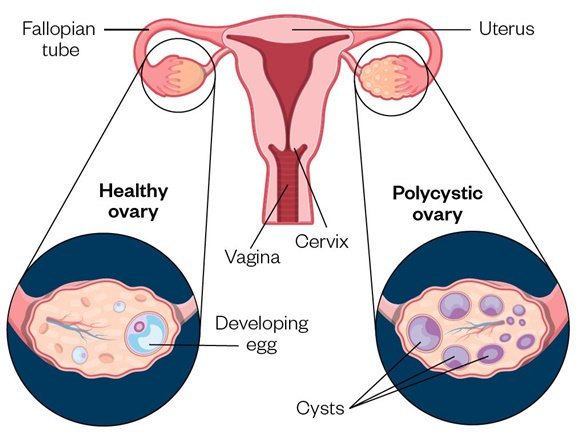 Ultrasound Scanner for Polycystic Ovarian Syndrome Assessment