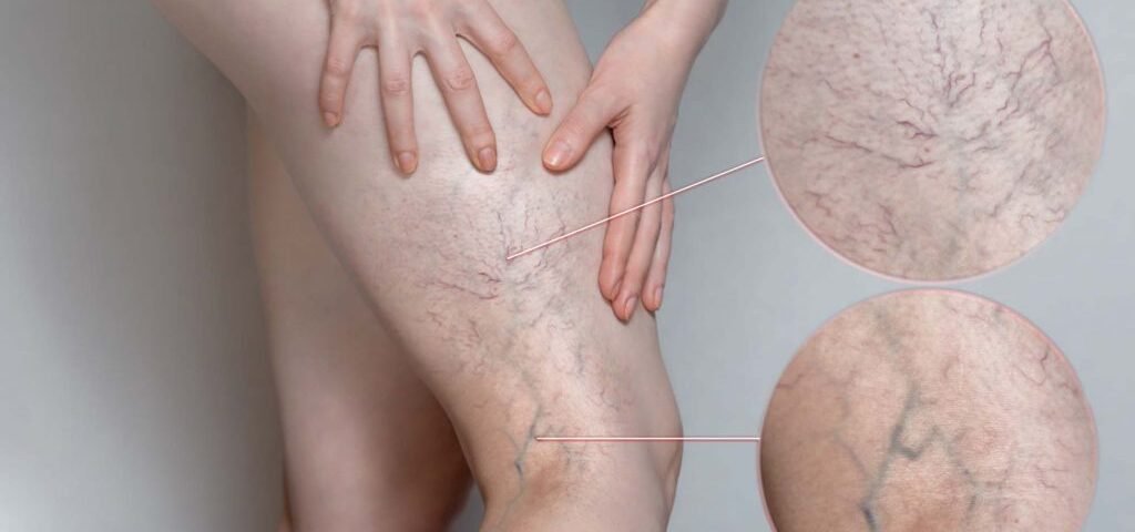 Sclerotherapy for Varicose and Spider Veins