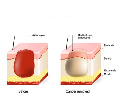 The Use of Ultrasound Scanners in Skin Tumor Removal