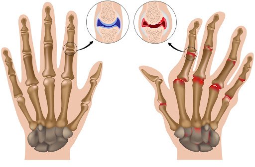 Hand osteoarthritis rehabilitation