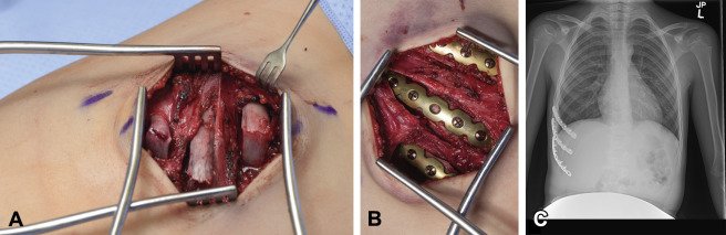 Surgical Stabilization of Rib Fractures